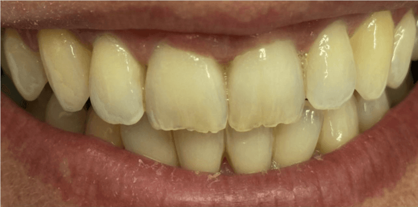 Blanqueamiento dental antes 1