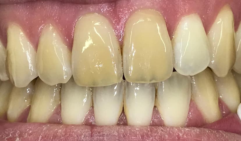 Blanqueamiento dental antes 2