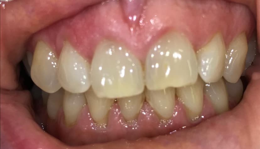 Blanqueamiento dental antes 3