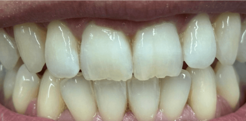 Blanqueamiento dental después 1