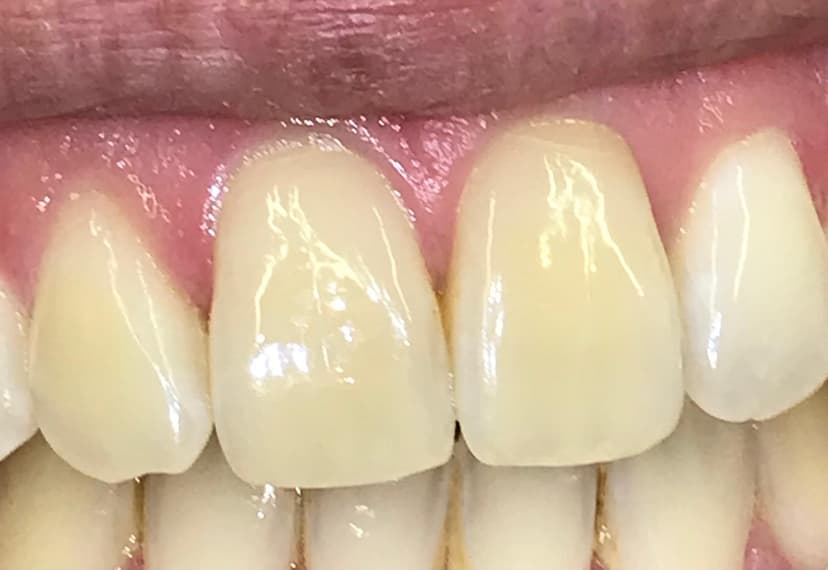 Blanqueamiento dental después 2
