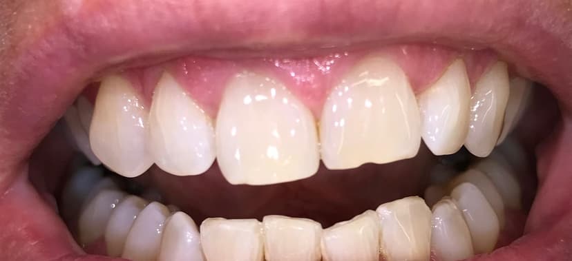 Blanqueamiento dental después 3