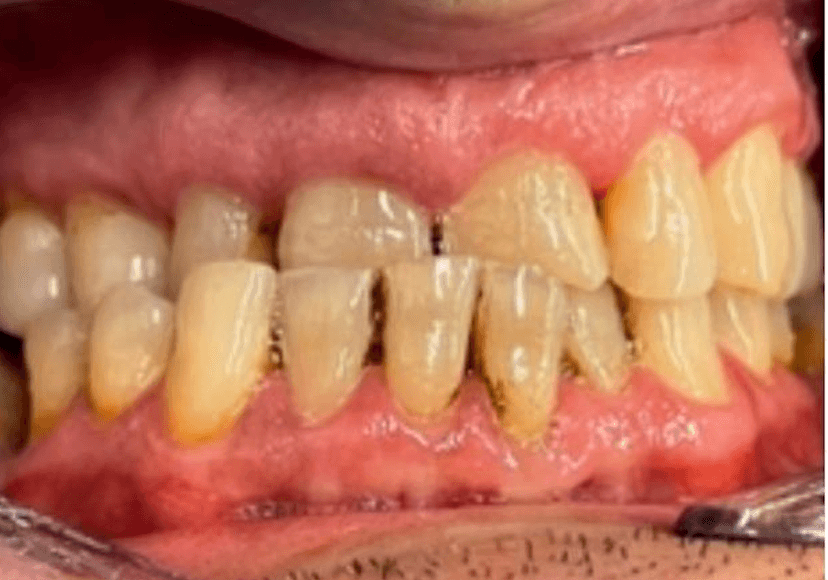Rehabilitación oral antes 1