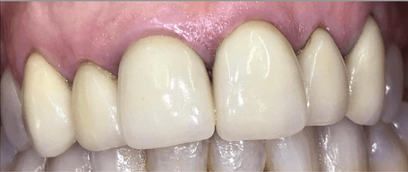 Rehabilitación oral antes 2