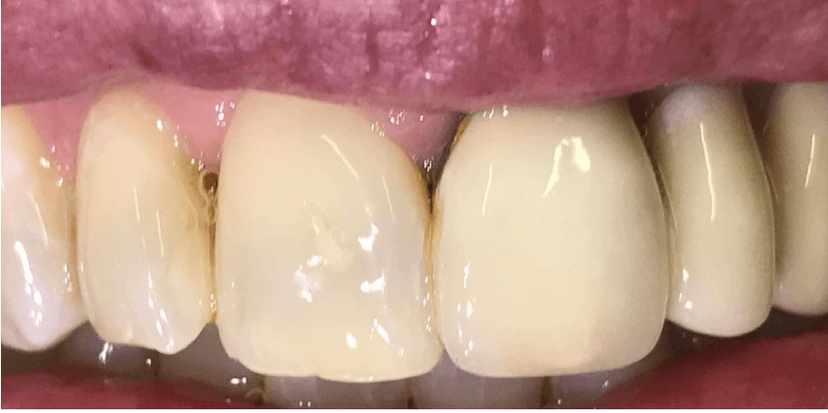 Rehabilitación oral antes 3