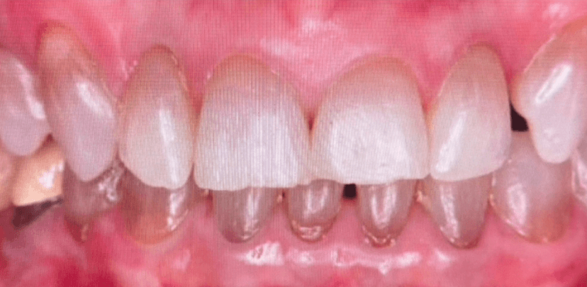 Rehabilitación oral antes 4