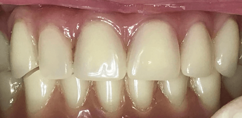 Rehabilitación oral antes 5