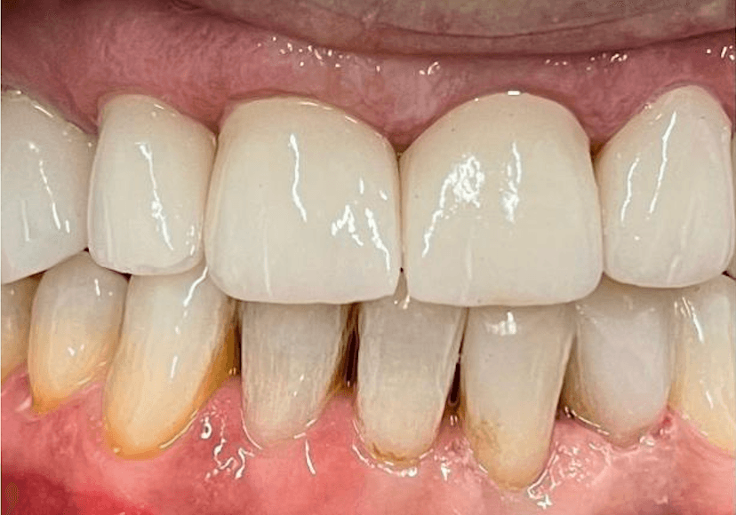 Rehabilitación oral después 1