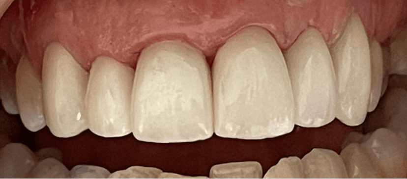 Rehabilitación oral después 2
