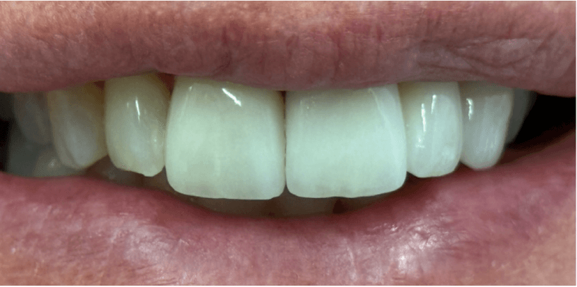 Rehabilitación oral después 3