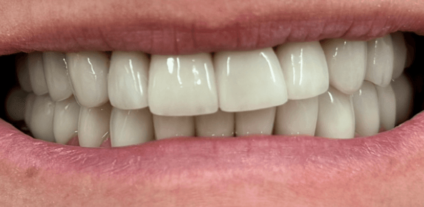 Rehabilitación oral después 4