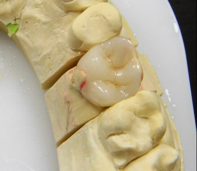 Odontología conservadora - empastes estéticos en Abad Dental Logroño