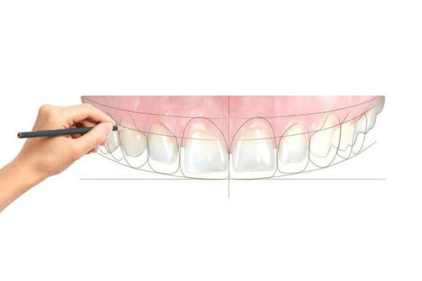 DSD - Diseño Digital de Sonrisa
