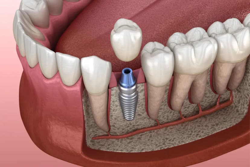 Implantes dentales de titanio en Abad Dental Logroño