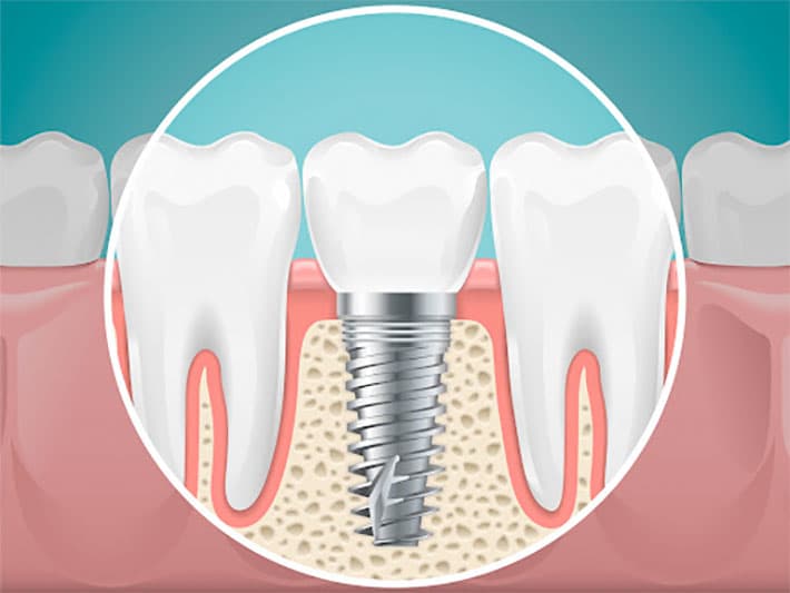 Tratamiento de Regeneración Ósea en Abad Dental Logroño