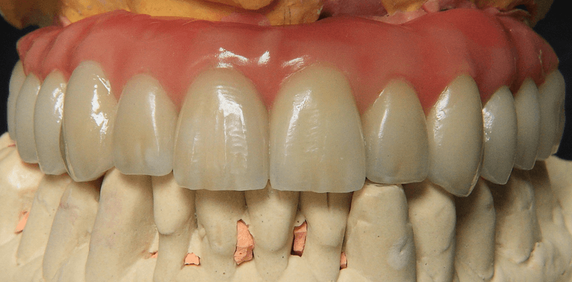 Rehabilitación oral completa en Abad Dental Logroño