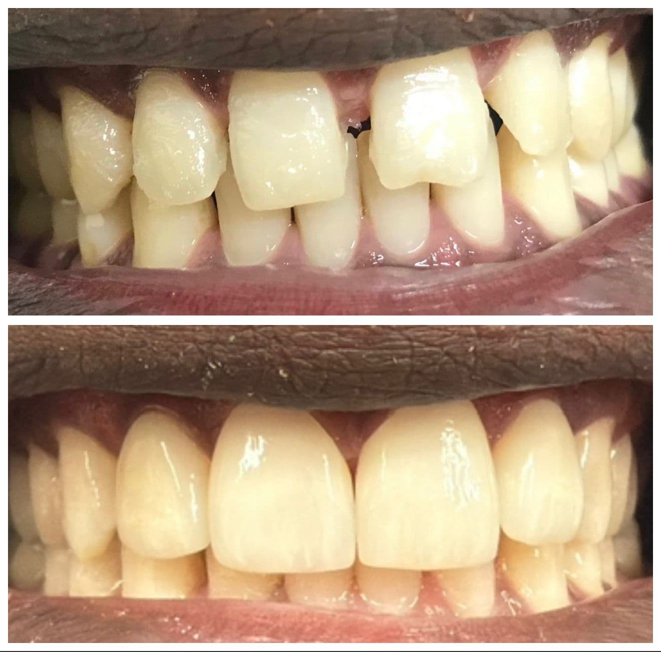 Antes y después de un tratamiento de carillas de porcelana en Abad Dental Logroño