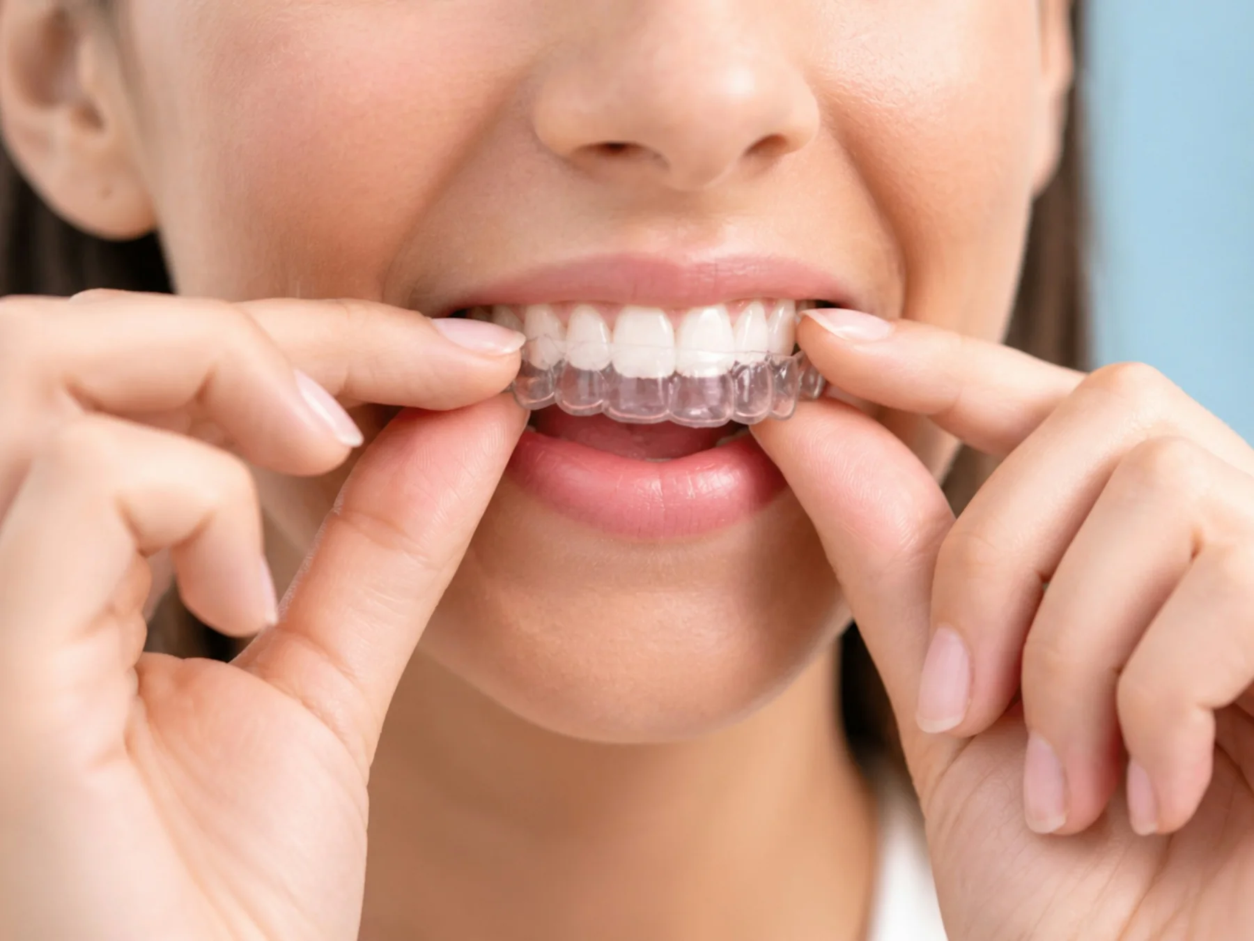 Colocación de alineadores transparentes de ortodoncia invisible en Abad Dental Logroño